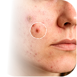 Manejo de complicaciones en limpieza facial